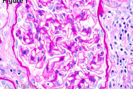 Renal oxalosis, arkana laboratories, teaching point at arkana Laboratories, renal pathology