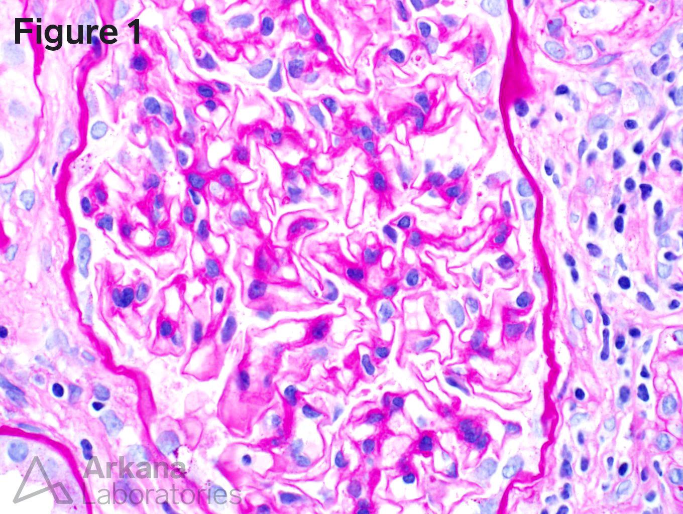 Renal oxalosis, arkana laboratories, teaching point at arkana Laboratories, renal pathology