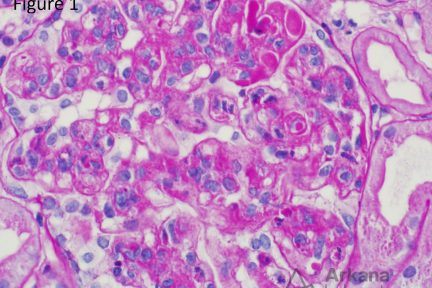 Lupus Nephritis, arkana laboratories, teaching point, nephropathology