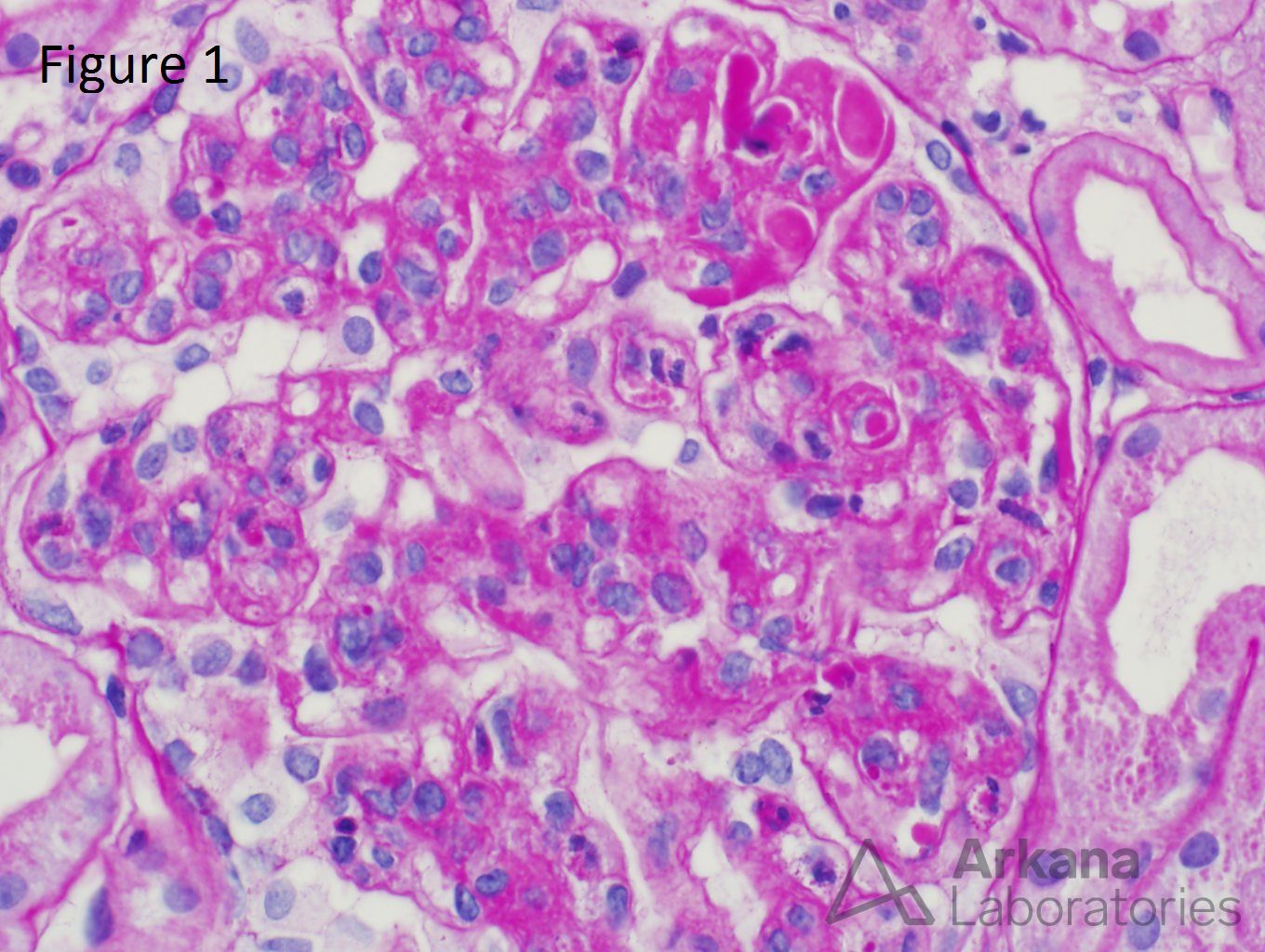 Lupus Nephritis, arkana laboratories, teaching point, nephropathology