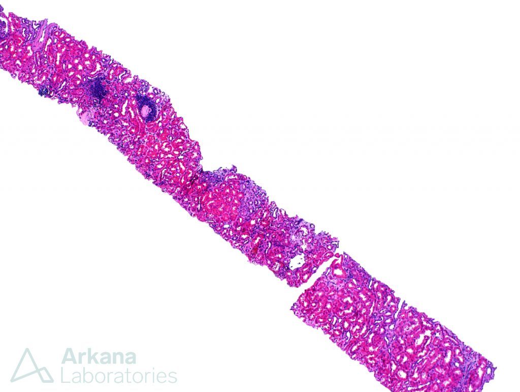 lymphoma, renal biopsy, pathology