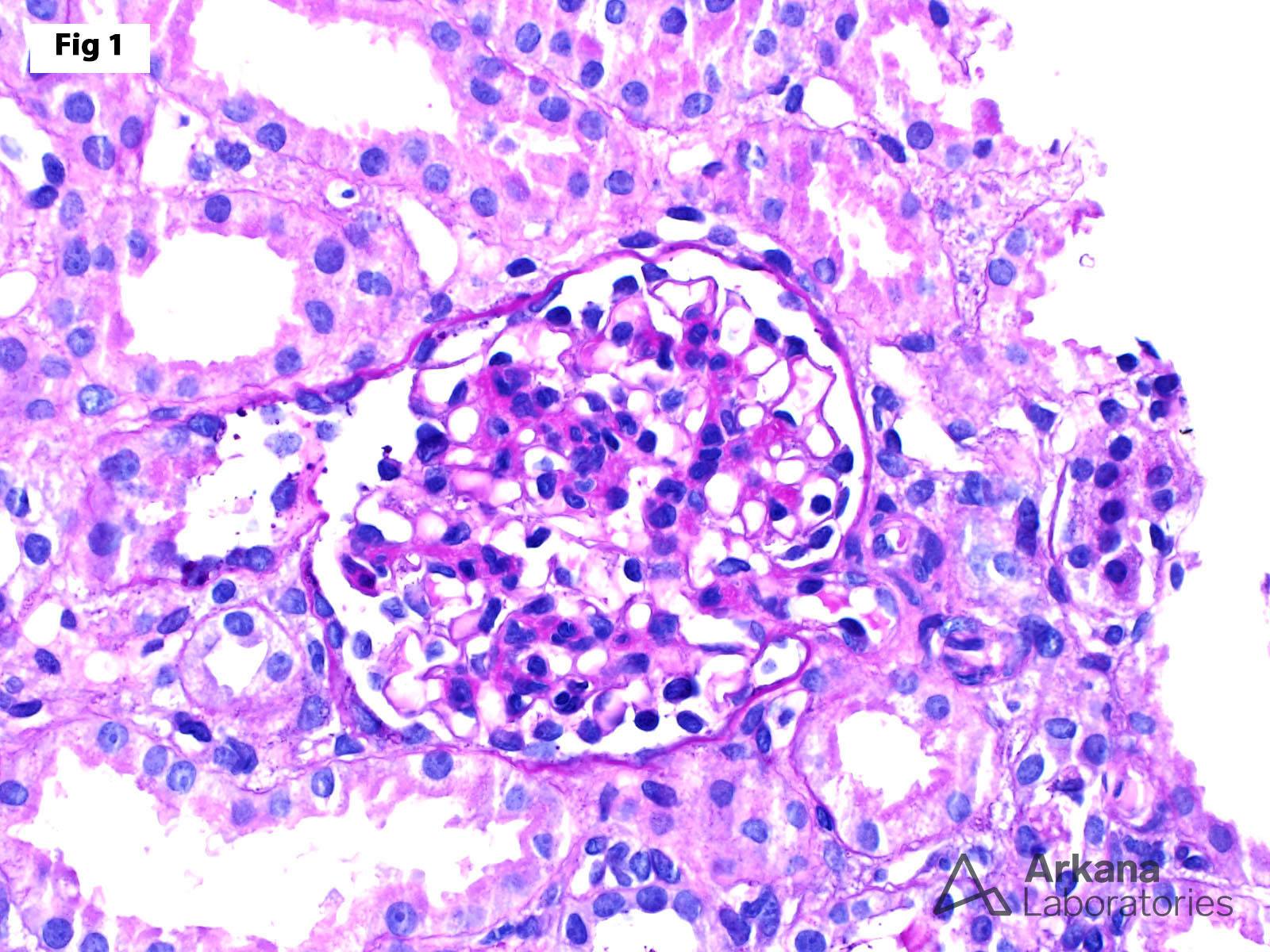 Diffuse Mesangial Hypercellularity