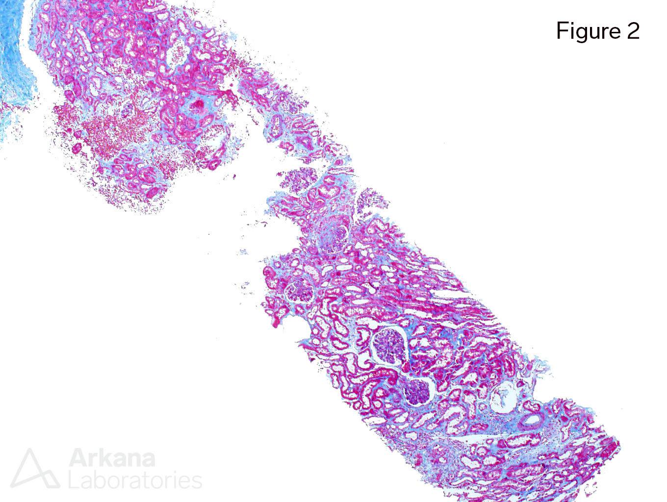 Infection-Associated Glomerulonephritis