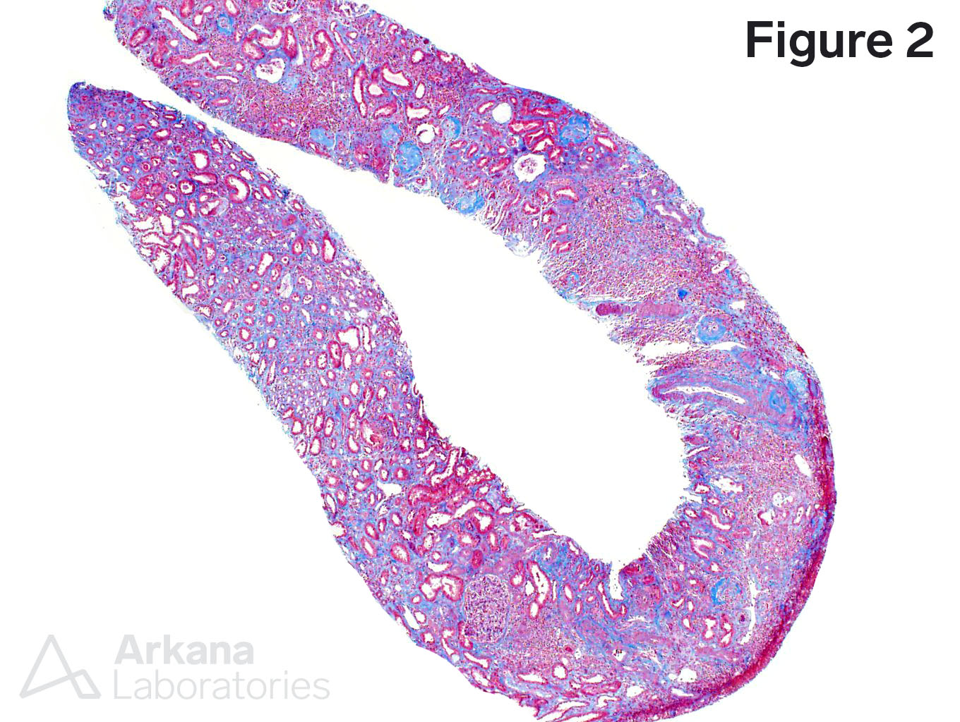 Renal oxalosis