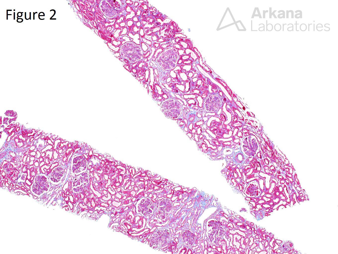 Lupus Nephritis