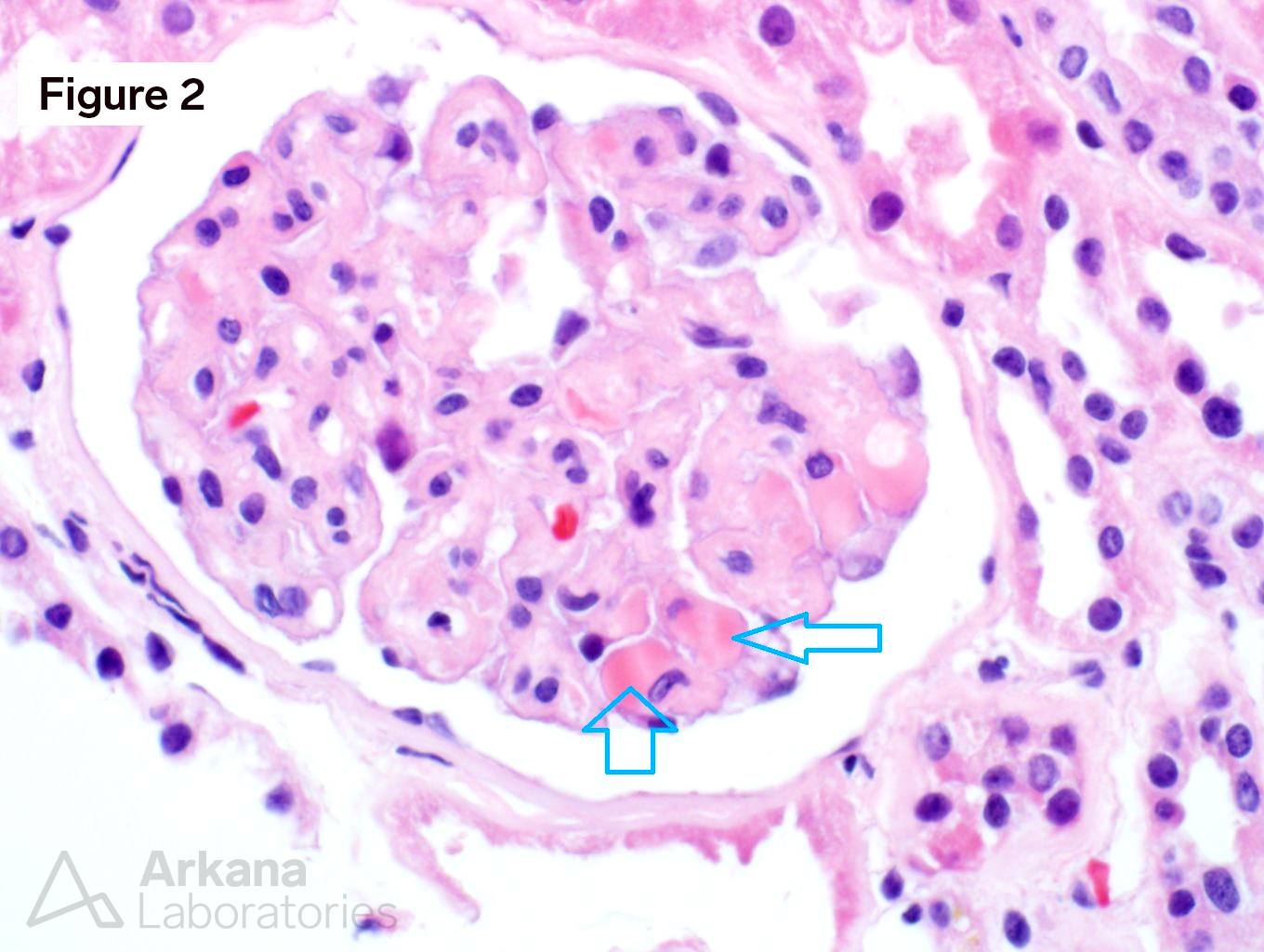 VEGF Inhibitor