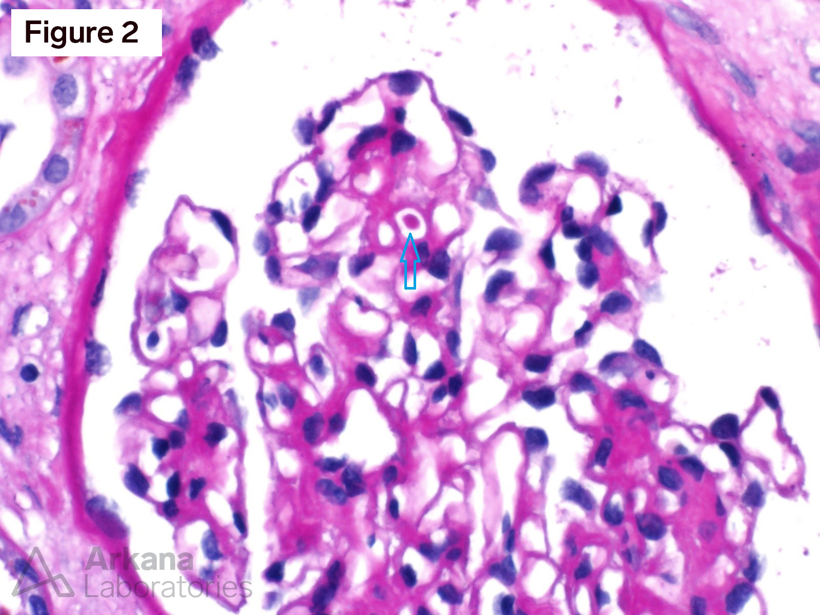 Cryoglobulinemic Glomerulonephritis