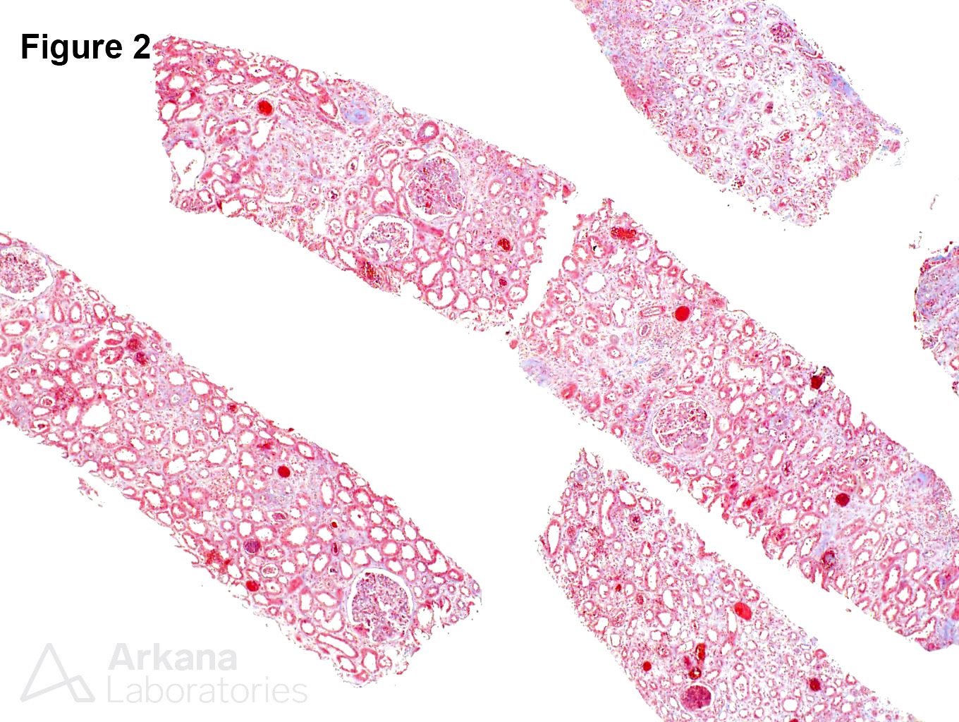 Crescentic IgA nephropathy, moderate tubular atrophy and interstitial fibrosis