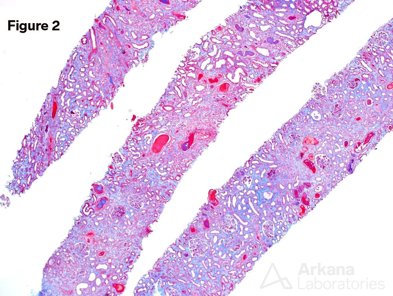 Light Chain Cast Nephropathy