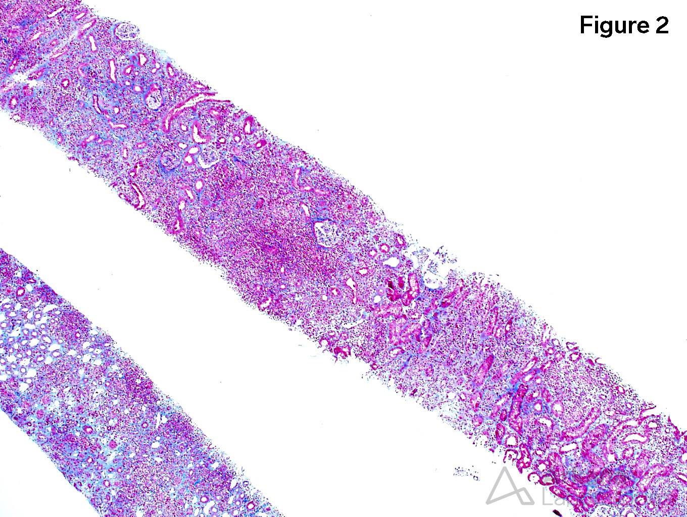 BK Nephritis