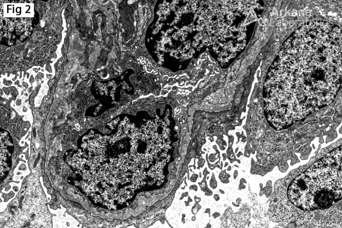 diffuse epithelial foot process effacement, irregular glomerular basement membranes, Diffuse Mesangial Sclerosis