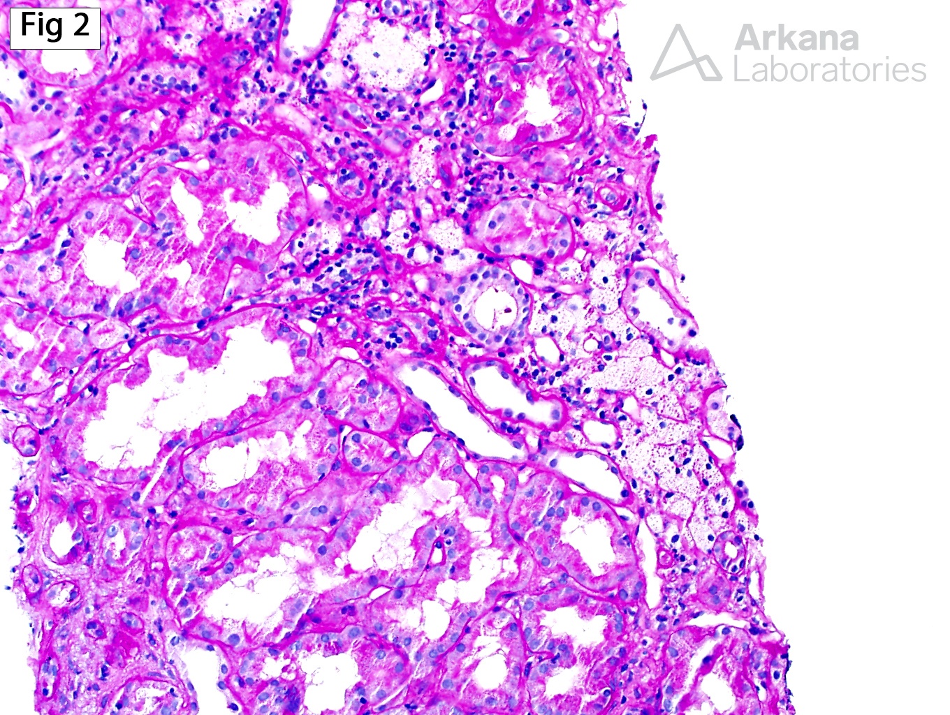 moderate interstitial fibrosis and tubular atrophy, frequent interstitial foam cells, Alport Syndrome