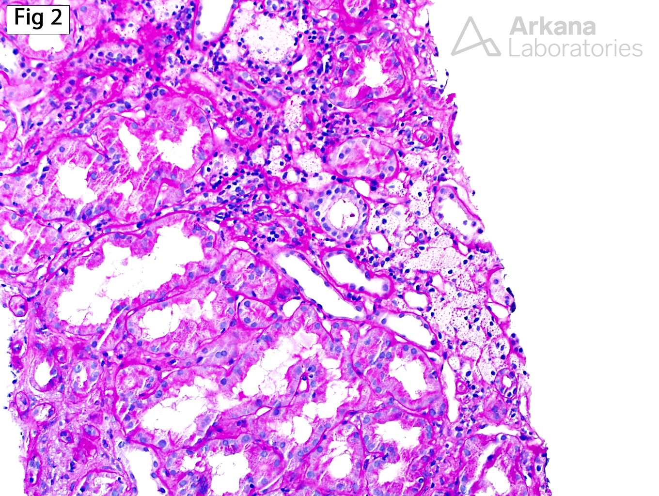 Alport Syndrome