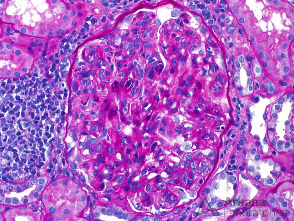 proliferative glomerulonephritis, MPGN, Arkana Laboratories