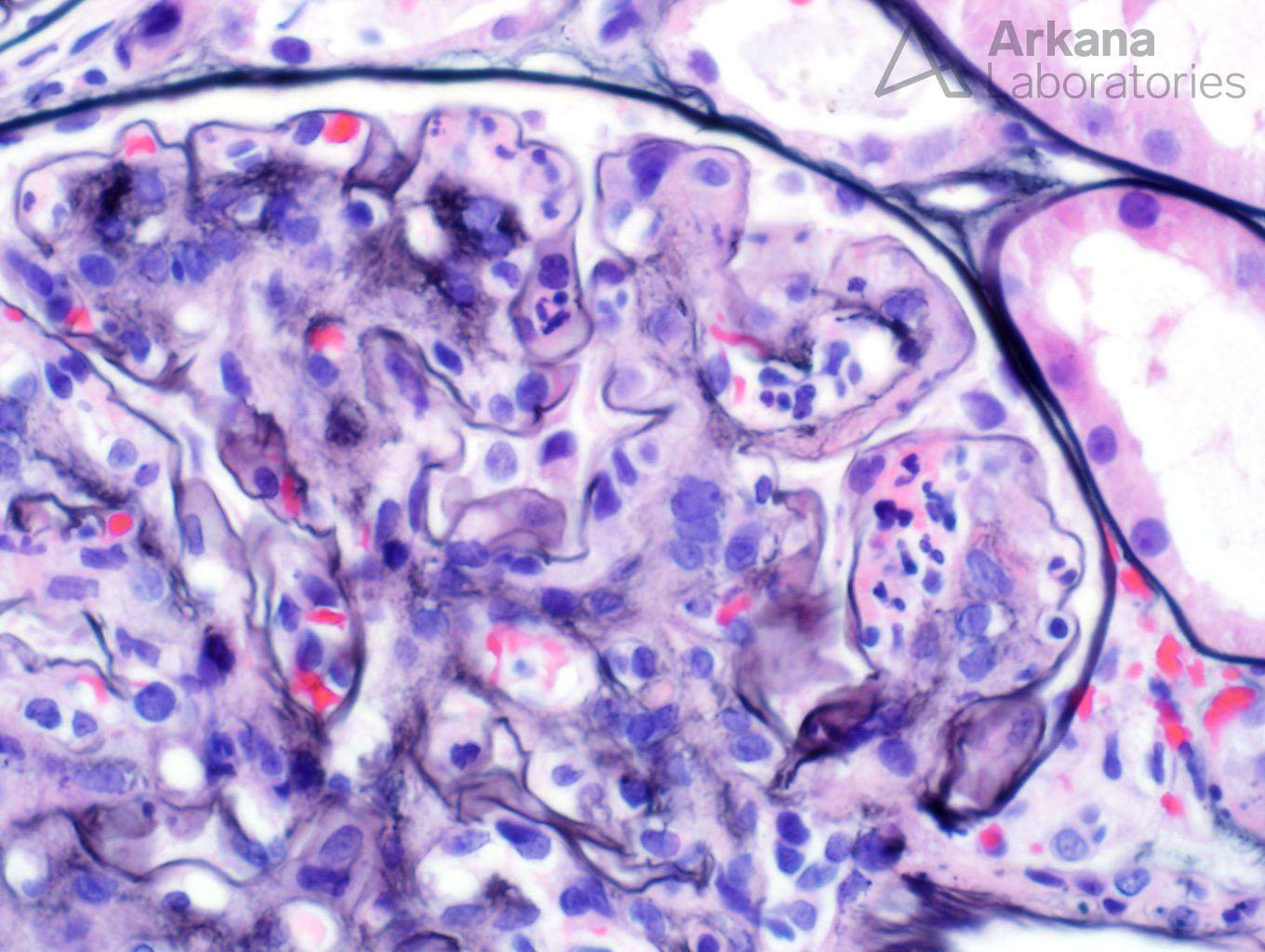 IgA Dominant Infection-Associated Glomerulonephritis