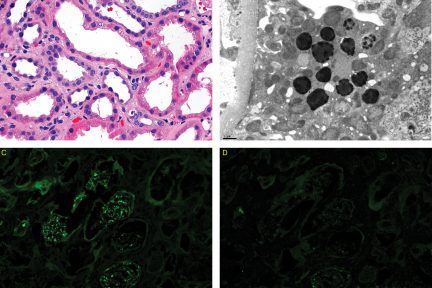 Light Chain Proximal Tubulopathy Without Crystals, light chain