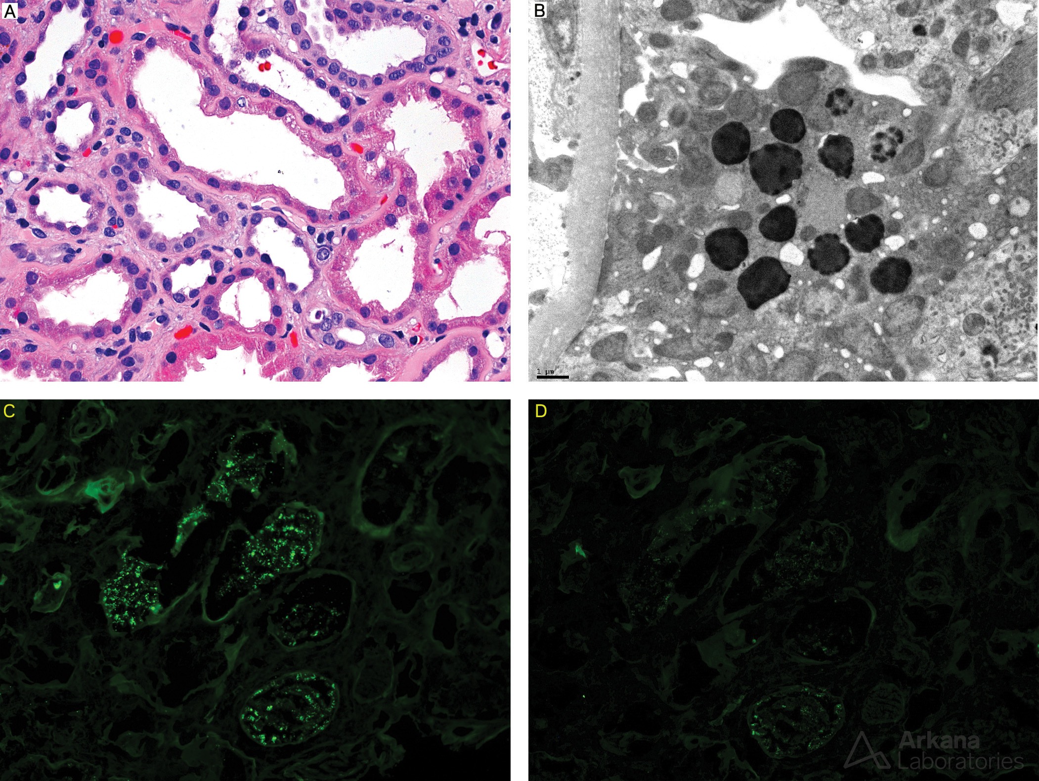 Light Chain Proximal Tubulopathy Without Crystals, light chain