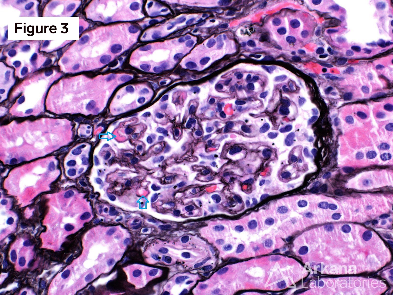 VEGF Inhibitor