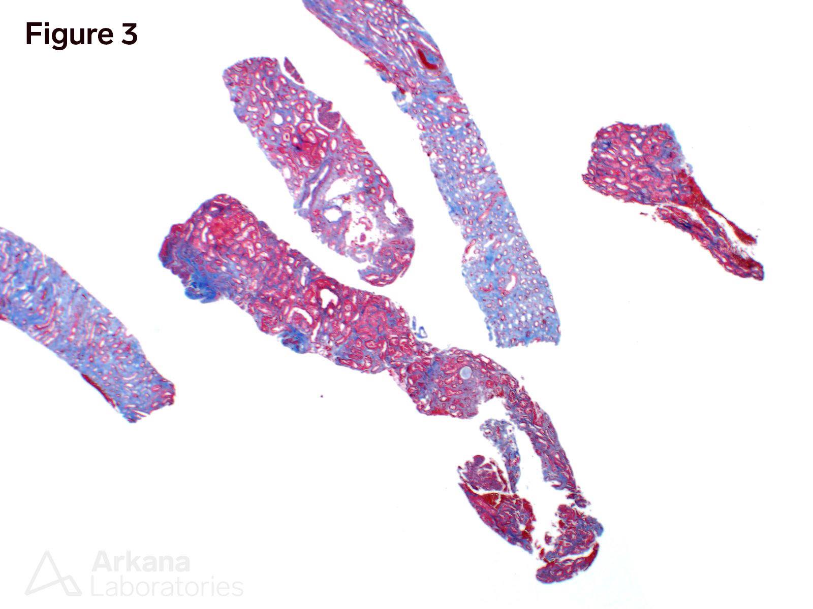 Cryoglobulinemic Glomerulonephritis