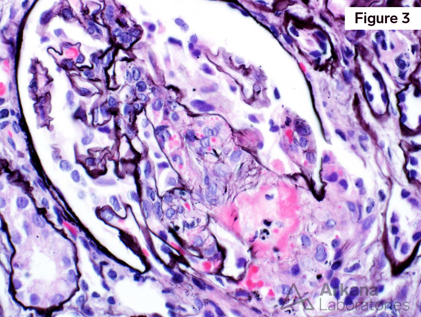 glomerulus in renal biopsy