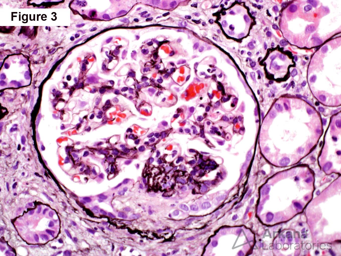 Crescentic IgA nephropathy, segmental cellular crescent