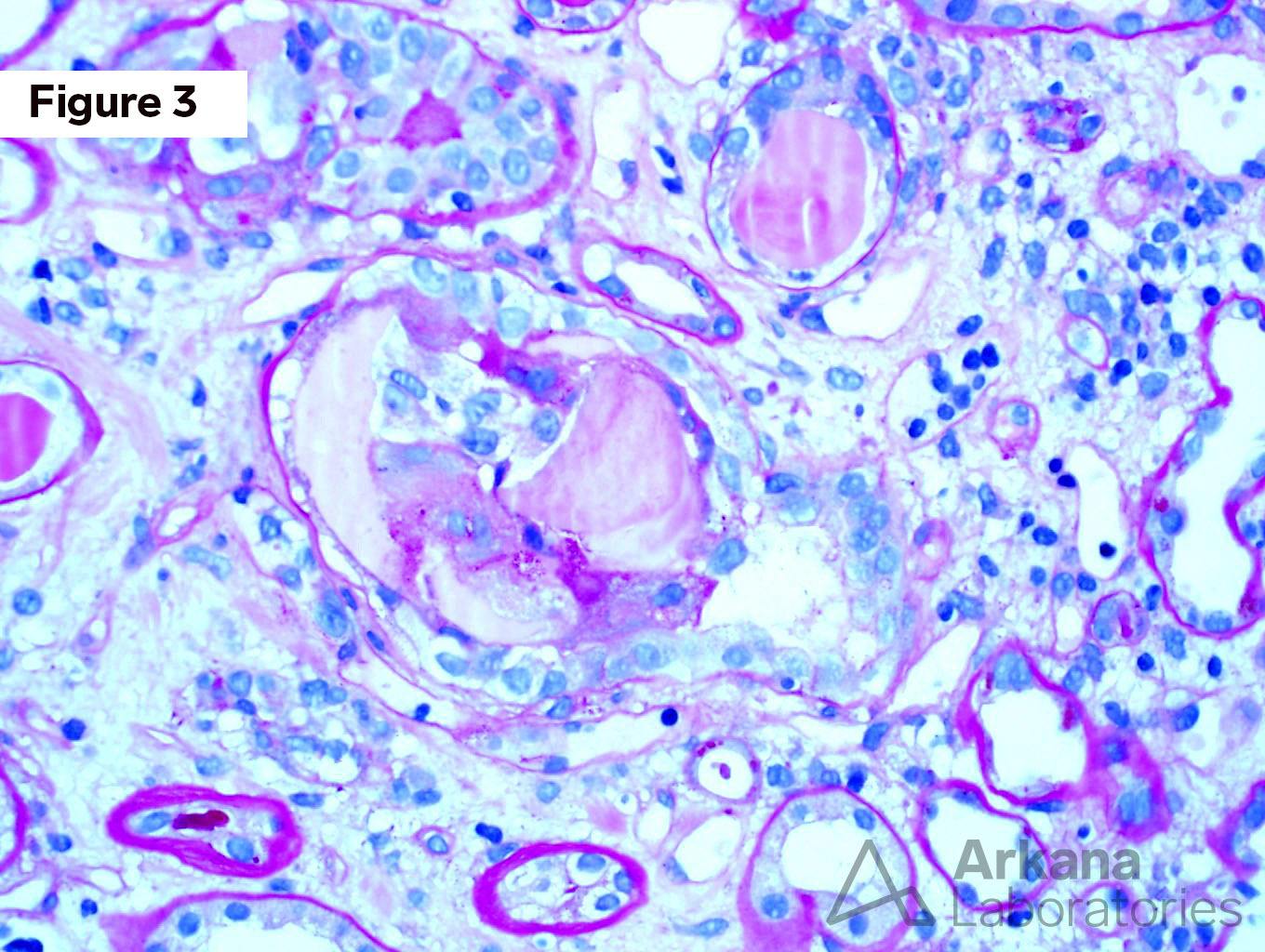 Light Chain Cast Nephropathy