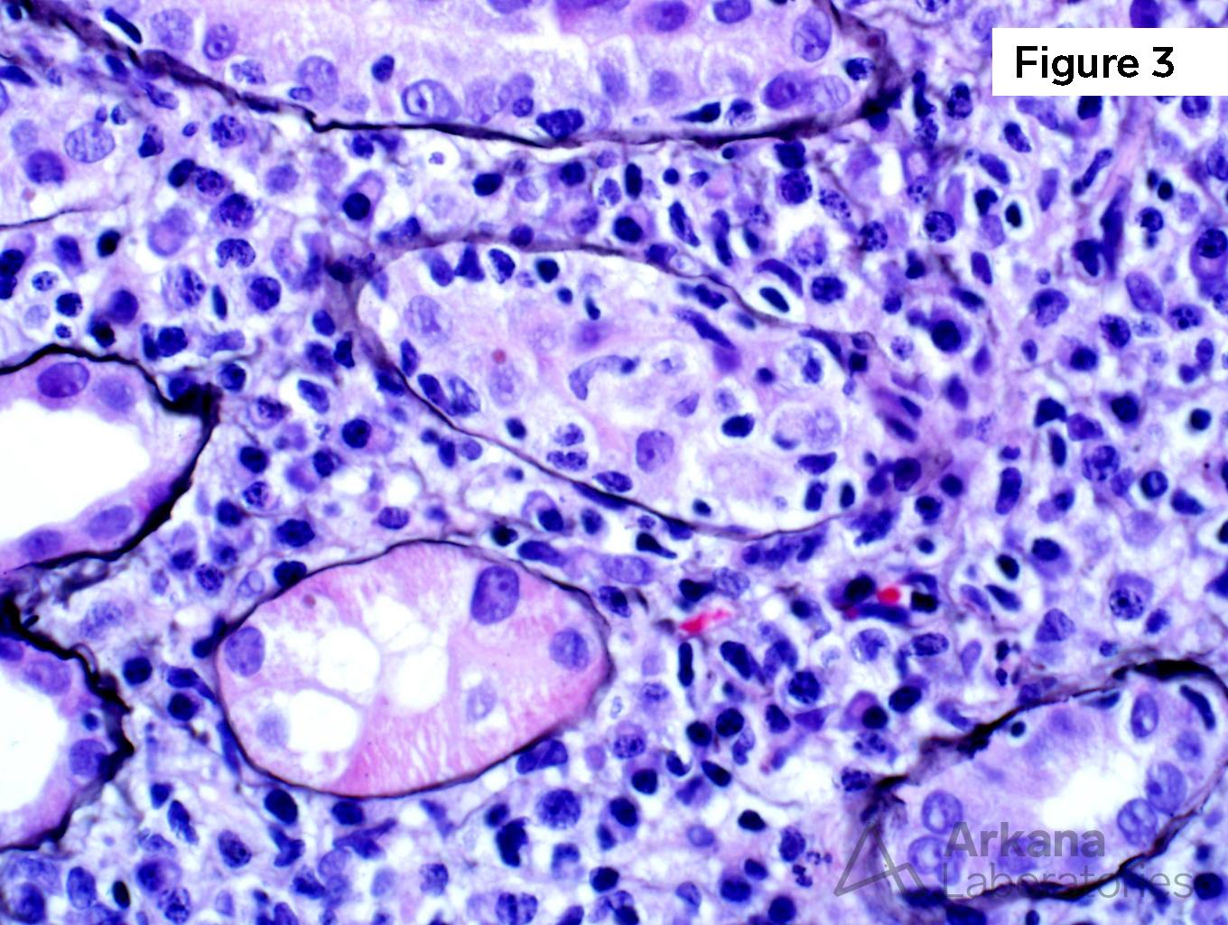 BK Nephritis