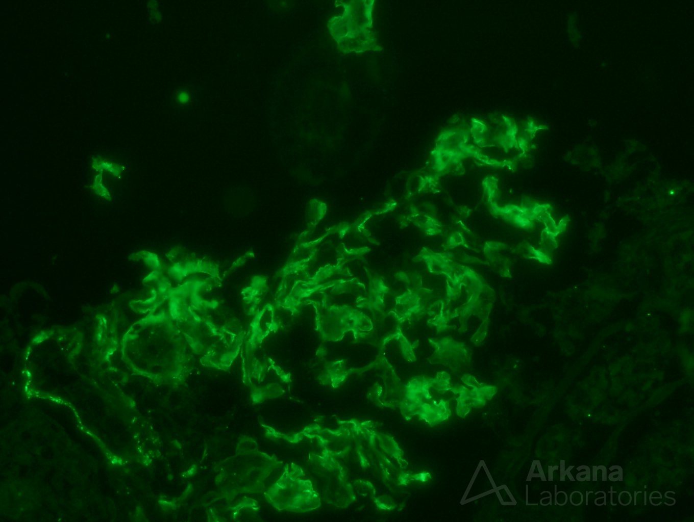 proteinuria