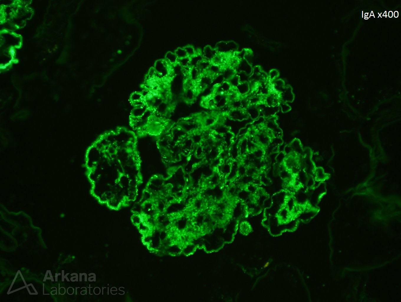 IgA Dominant Infection-Associated Glomerulonephritis