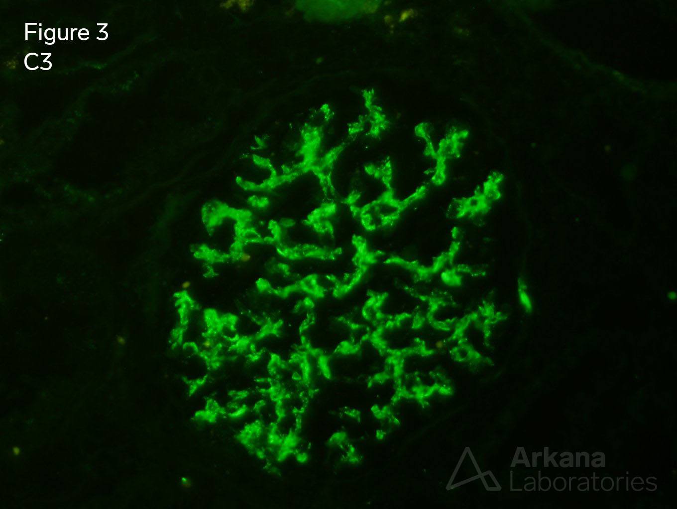 Infection-Associated Glomerulonephritis