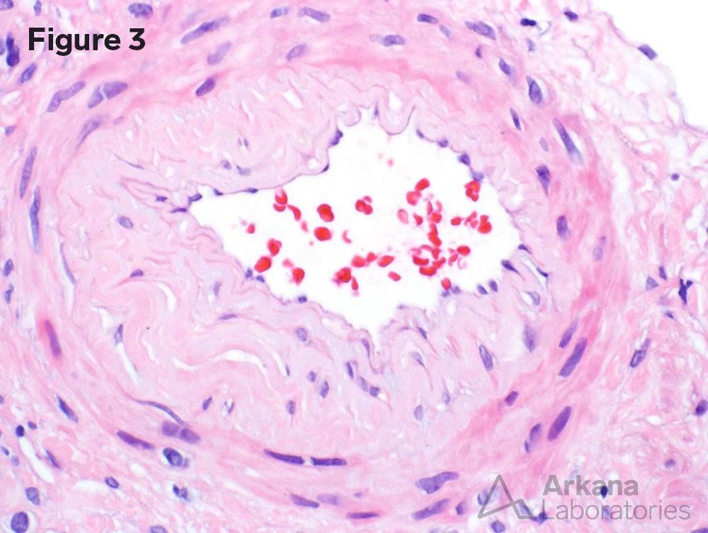 renal biopsy stain at Arkana Laboratories that shows Minimal Change Disease