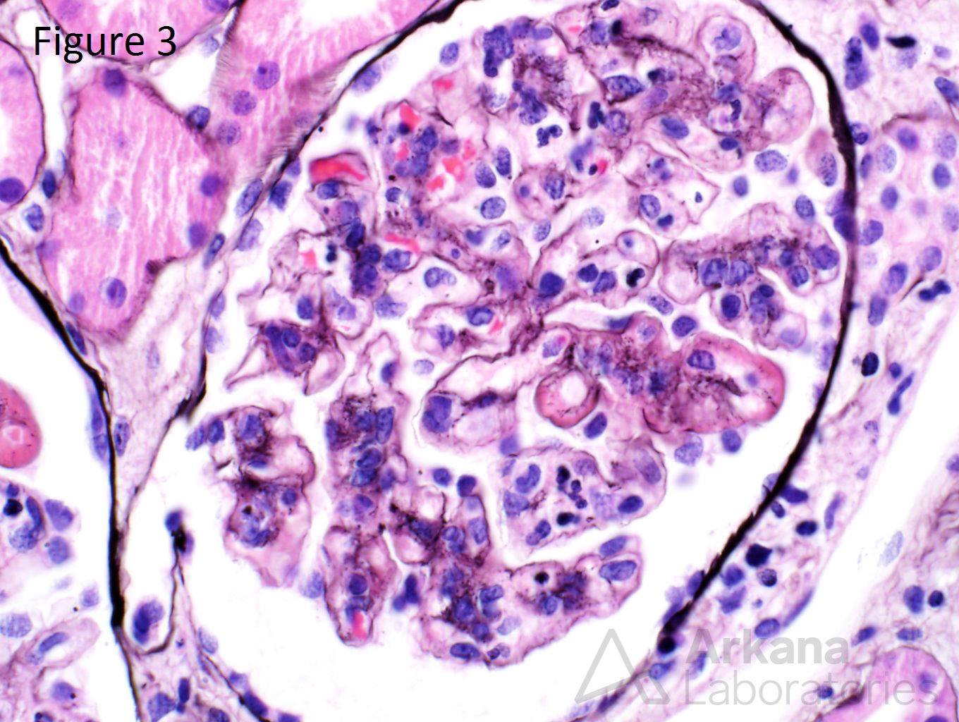 Lupus Nephritis