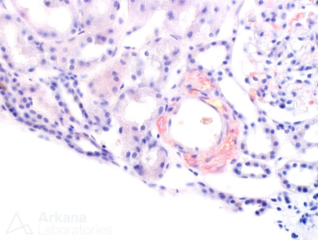 renal pathology stain at arkana laboratories 