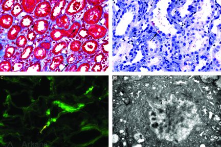 Light Chain Proximal Tubulopathy Amyloid Proximal Tubulopathy Type, renal biopsy, kidney pathology, arkana laboratories