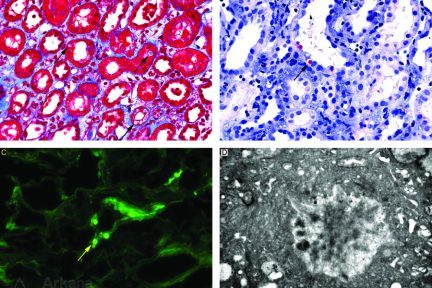 Light Chain Proximal Tubulopathy Amyloid Proximal Tubulopathy Type, renal biopsy, kidney pathology, arkana laboratories