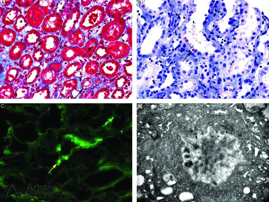 Light Chain Proximal Tubulopathy Amyloid Proximal Tubulopathy Type, renal biopsy, kidney pathology, arkana laboratories