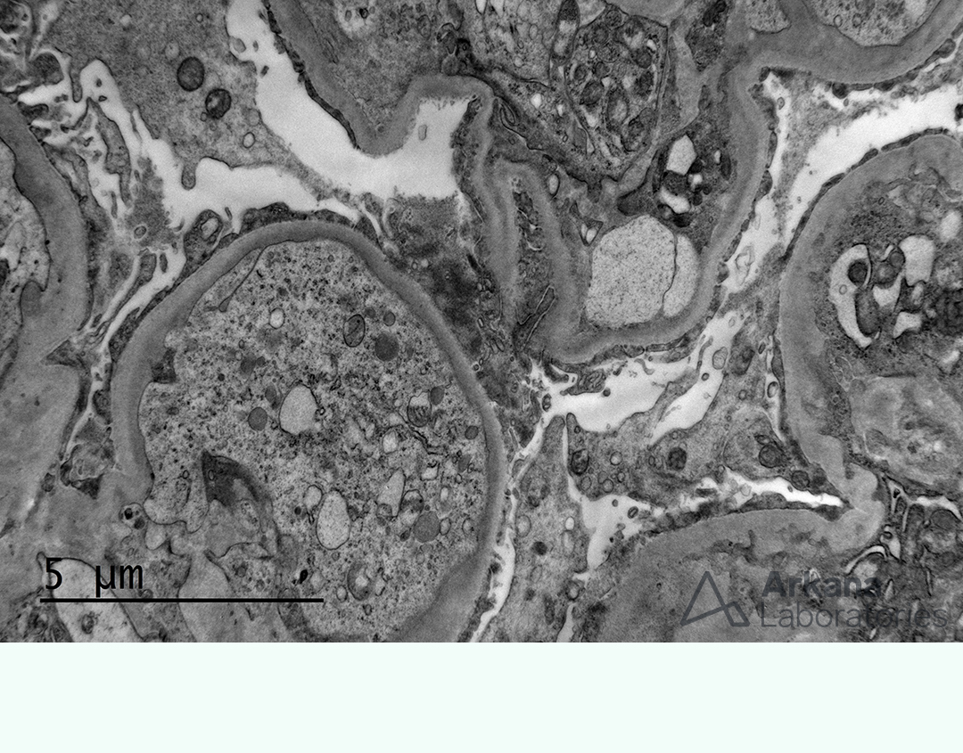 proteinuria