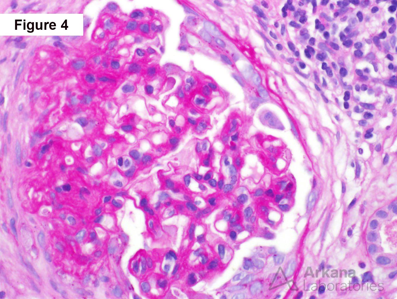 Crescentic IgA nephropathy, segmental cellular crescent