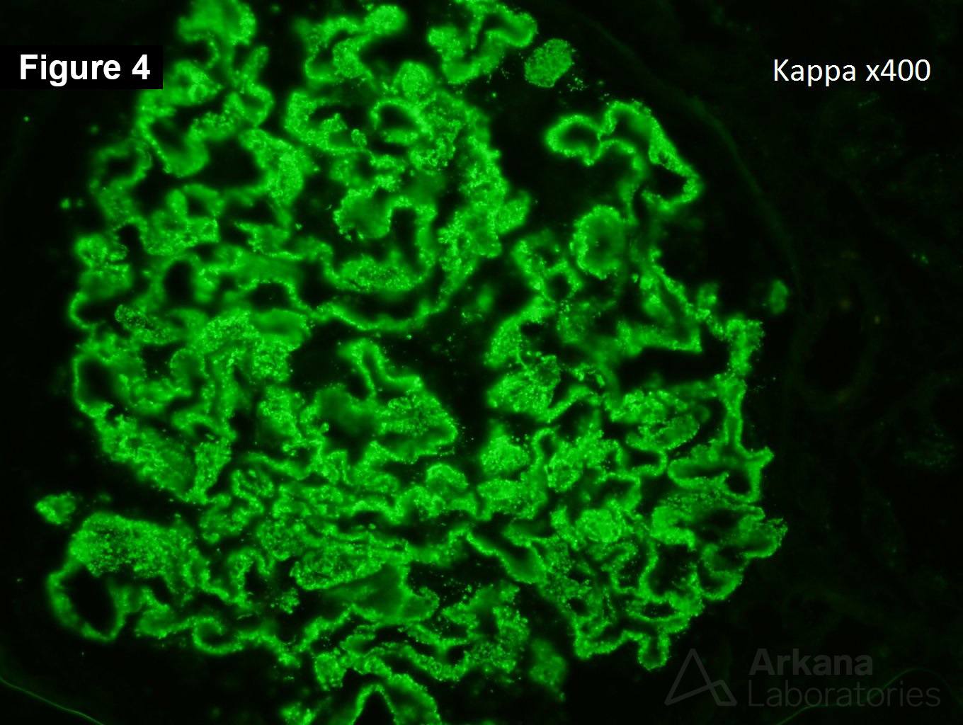 Membranous Nephropathy After Transplantation
