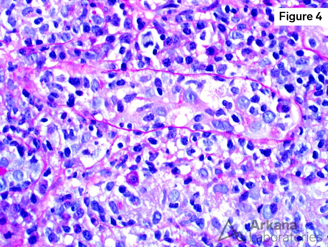 BK Nephritis