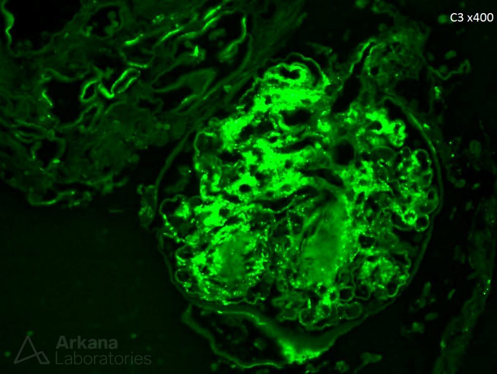 C3 renal pathology stain, IgA Dominant Infection-Associated Glomerulonephritis