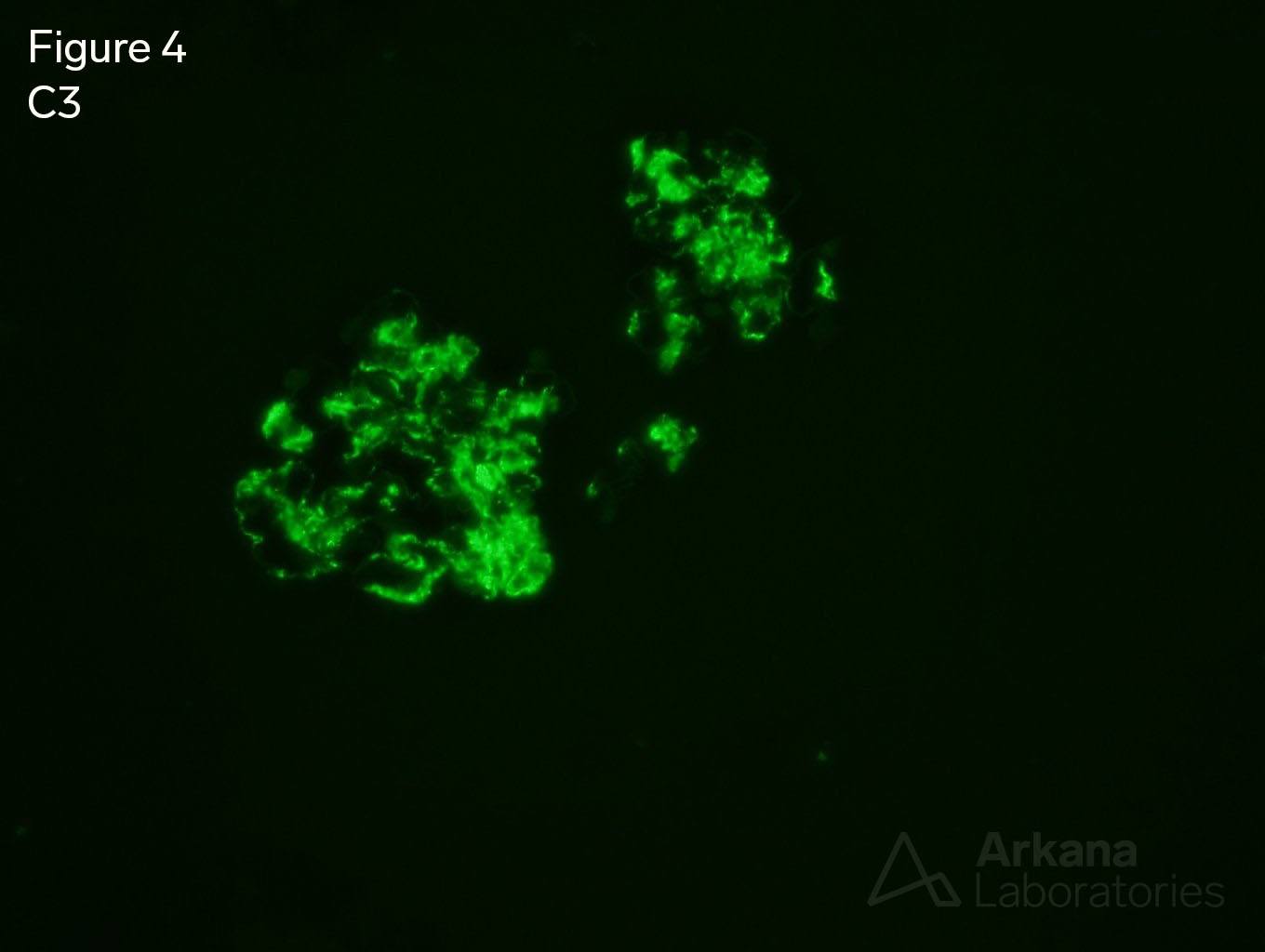 Infection-Associated Glomerulonephritis