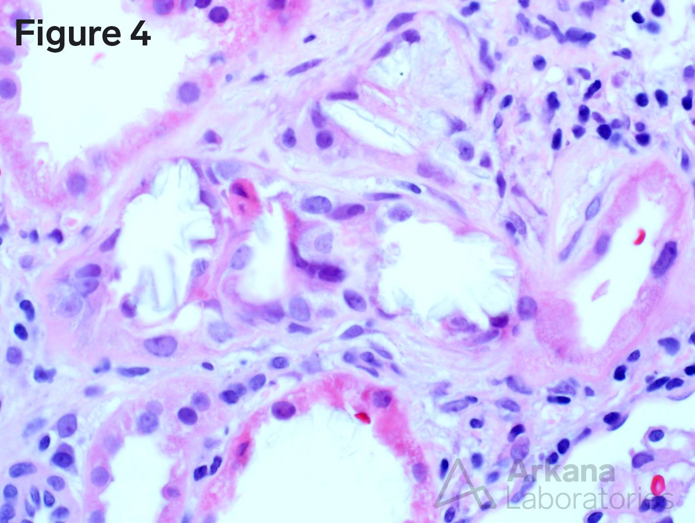 Renal oxalosis