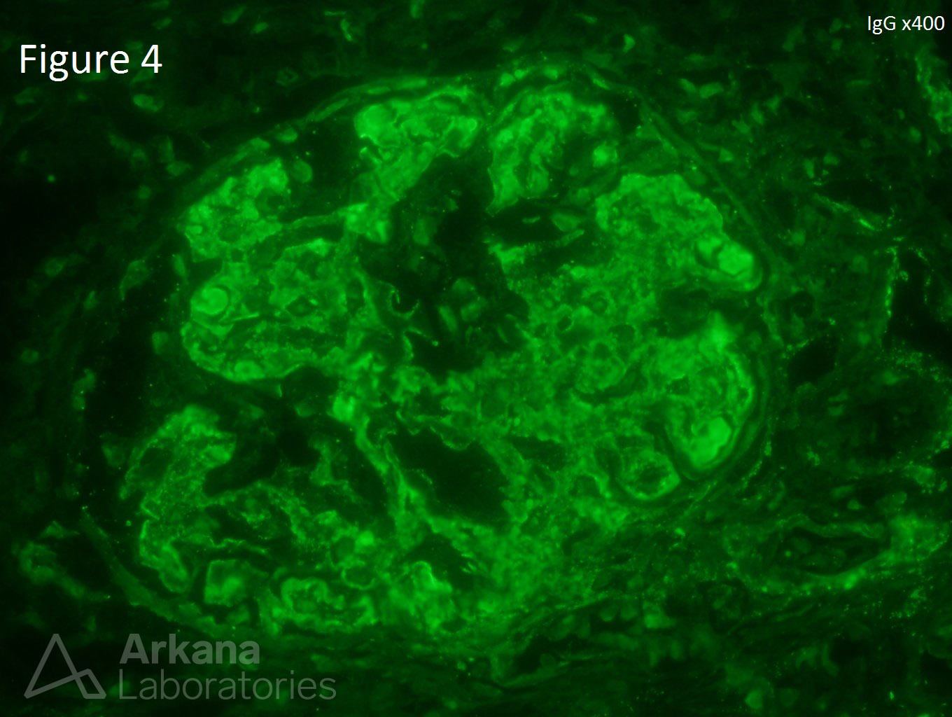 Lupus Nephritis