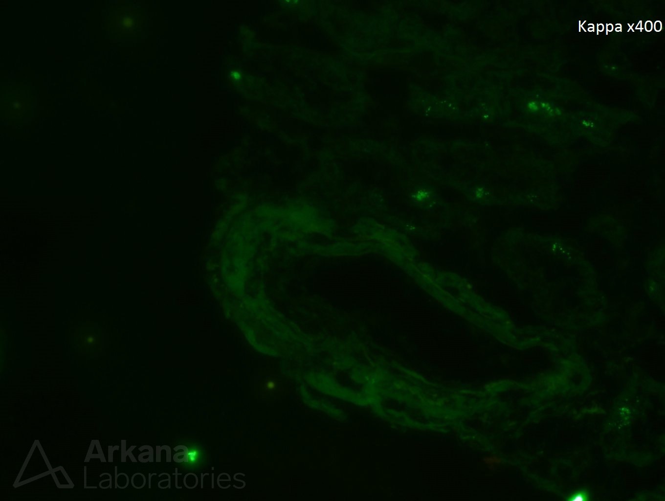 AL Amyloidosis