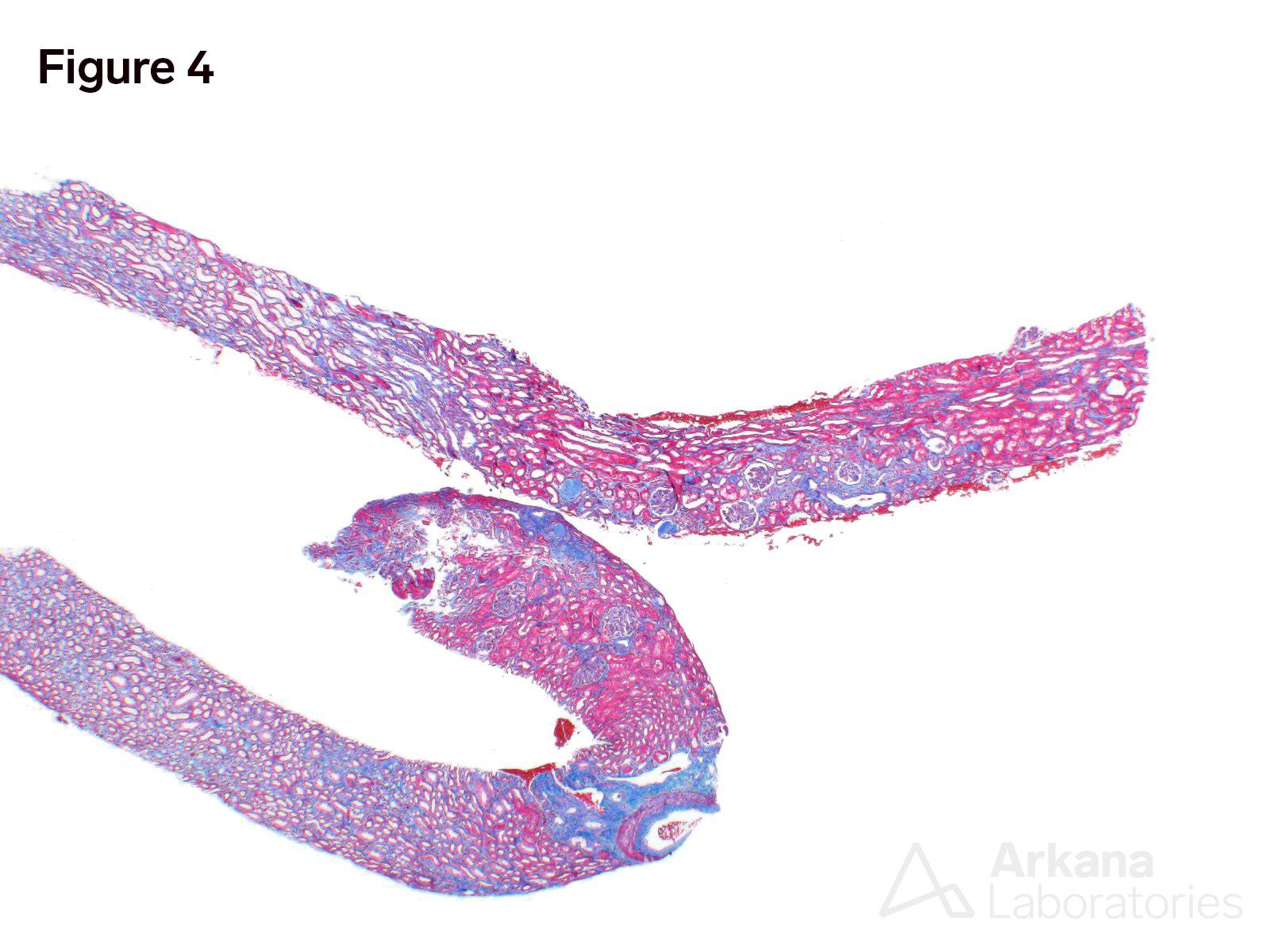 VEGF Inhibitor