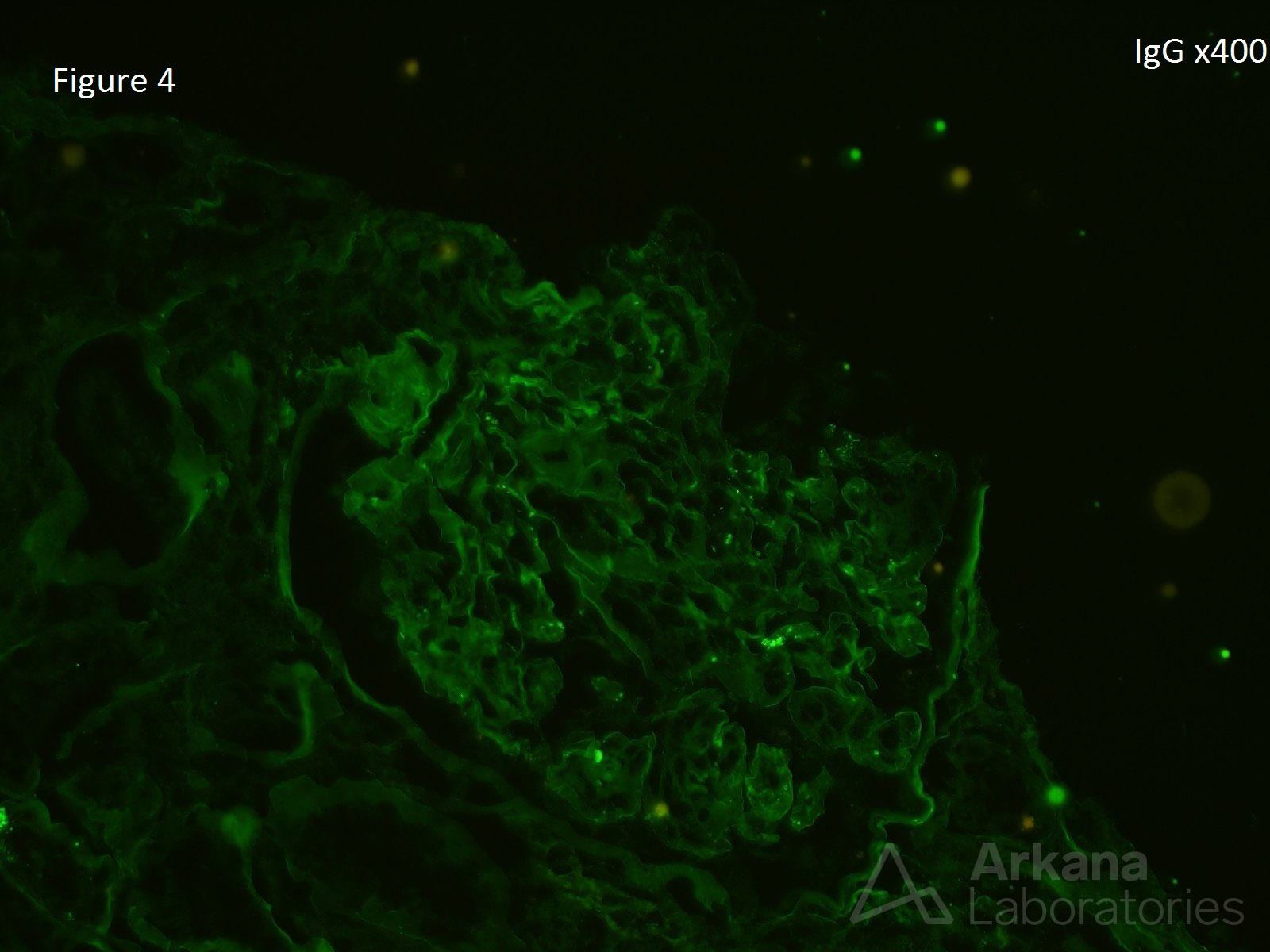 Cryoglobulinemic Glomerulonephritis