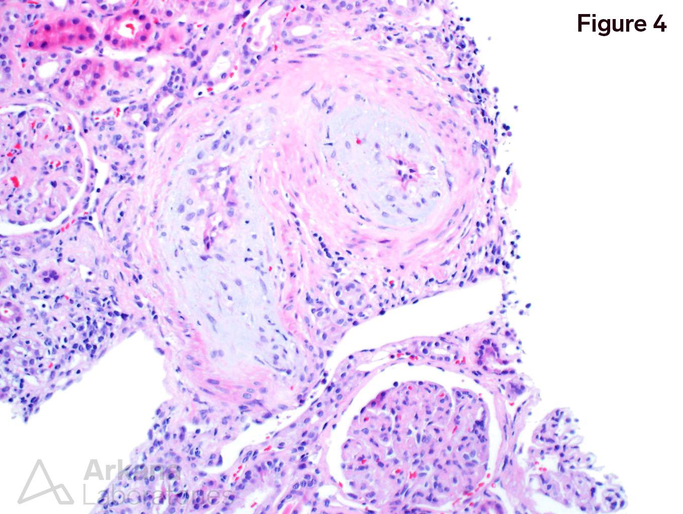 Scleroderma