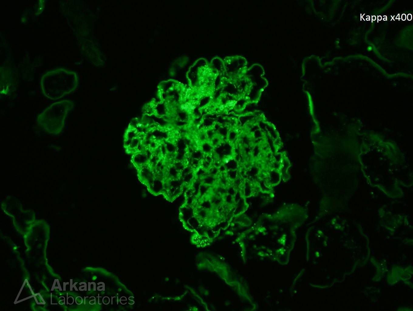 IgA Dominant Infection-Associated Glomerulonephritis