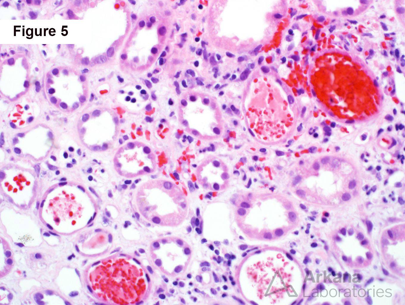 Crescentic IgA nephropathy, red blood cell casts